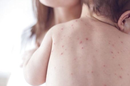 Відтепер безкоштовно щепитися від кору можуть тернополяни будь-якого віку